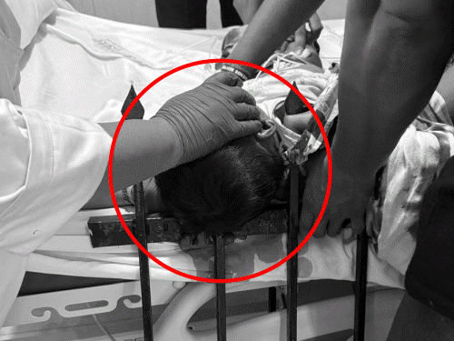 3 साल के बच्चे के सिर-कंधे के आर-पार हुई ग्रिल:हार्टअटैक पीड़ित मां को छोड़कर पहुंचे डॉक्टर, लखनऊ में 25 हजार में 15 लाख की सर्जरी